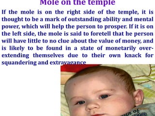 Mole on the temple
If the mole is on the right side of the temple, it is
thought to be a mark of outstanding ability and mental
power, which will help the person to prosper. If it is on
the left side, the mole is said to foretell that he person
will have little to no clue about the value of money, and
is likely to be found in a state of monetarily over-
extending themselves due to their own knack for
squandering and extravagance
 