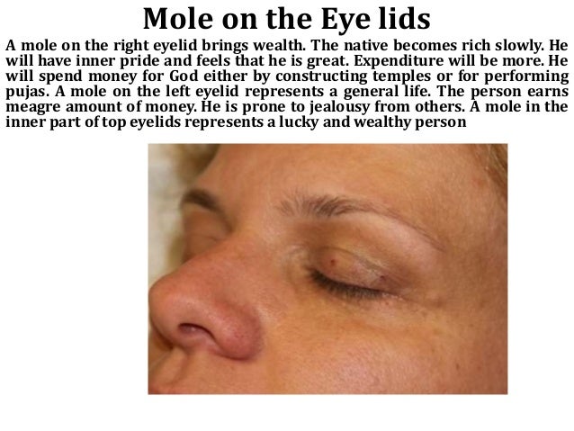 Moles On Body moles on body