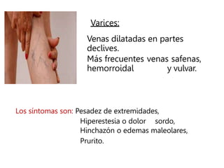 Varices:
Venas dilatadas en partes
declives.
Más frecuentes venas safenas,
hemorroidal y vulvar.
Los síntomas son: Pesadez de extremidades,
Hiperestesia o dolor sordo,
Hinchazón o edemas maleolares,
Prurito.
 