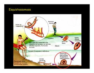 Esquistossomose
 