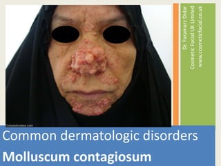 Common dermatologic disorders
Molluscum contagiosum
Dr.FaramarzDidar
CosmeticFacialUKLimited
www.cosmeticfacial.co.uk
 