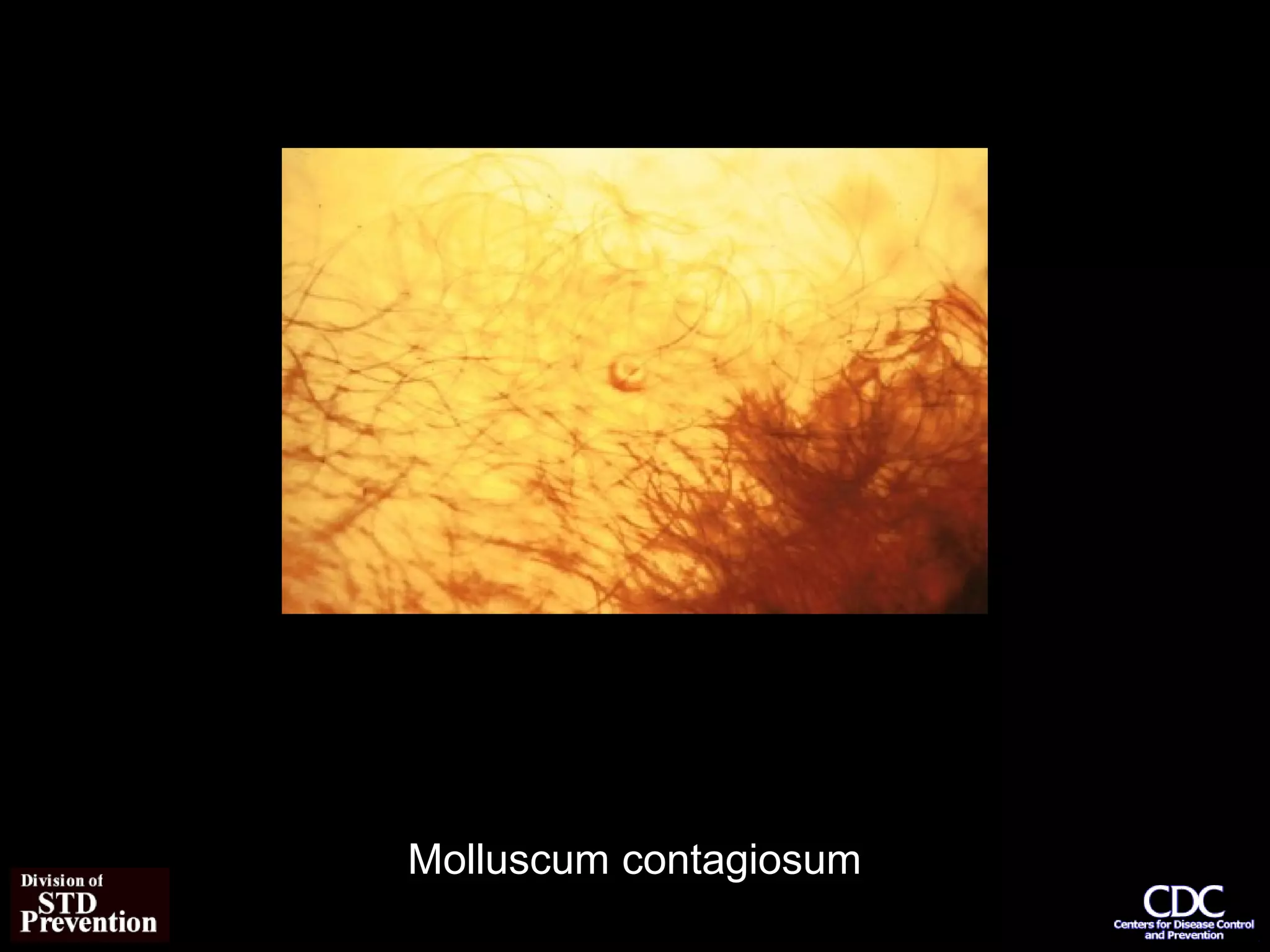 Molluscum Contagiosum Or Hpv? Spot The Difference - u82zvum