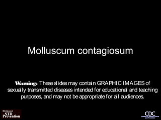 Molluscum contagiosum


   W arning: These slides may contain GRAPHIC IMAGES of
sexually transmitted diseases intended for educational and teaching
     purposes, and may not be appropriate for all audiences.
 
