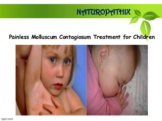 NATUROPATHIX
Painless Molluscum Contagiosum Treatment for Children
 