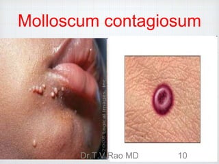 Molloscum contagiosum
Dr.T.V.Rao MD 10
 