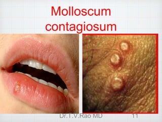 Molloscum
contagiosum
Dr.T.V.Rao MD 11
 
