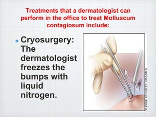 Treatments that a dermatologist can
perform in the office to treat Molluscum
contagiosum include:
Cryosurgery:
The
dermatologist
freezes the
bumps with
liquid
nitrogen.
 