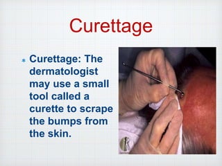 Curettage
Curettage: The
dermatologist
may use a small
tool called a
curette to scrape
the bumps from
the skin.
 