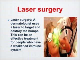 Laser surgery
Laser surgery: A
dermatologist uses
a laser to target and
destroy the bumps.
This can be an
effective treatment
for people who have
a weakened immune
system
 