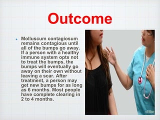 Outcome
Molluscum contagiosum
remains contagious until
all of the bumps go away.
If a person with a healthy
immune system opts not
to treat the bumps, the
bumps will eventually go
away on their own without
leaving a scar. After
treatment, a person may
get new bumps for as long
as 6 months. Most people
have complete clearing in
2 to 4 months.
 