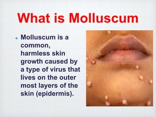 What is Molluscum
Molluscum is a
common,
harmless skin
growth caused by
a type of virus that
lives on the outer
most layers of the
skin (epidermis).
 