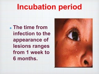 Incubation period
The time from
infection to the
appearance of
lesions ranges
from 1 week to
6 months.
 