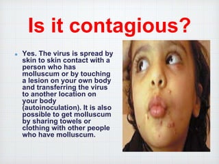 Is it contagious?
Yes. The virus is spread by
skin to skin contact with a
person who has
molluscum or by touching
a lesion on your own body
and transferring the virus
to another location on
your body
(autoinoculation). It is also
possible to get molluscum
by sharing towels or
clothing with other people
who have molluscum.
 