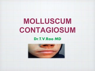 MOLLUSCUM
CONTAGIOSUM
Dr.T.V.Rao MD
 