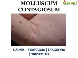 MOLLUSCUM
CONTAGIOSUM
CAUSES | SYMPTOMS | DIAGNOSIS
| TREATMENT
 