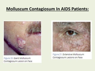 Molluscum Contagiosum In AIDS Patients:
 