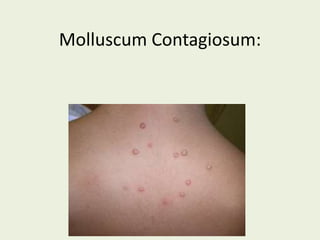 Molluscum Contagiosum:
 
