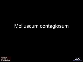 Molluscum contagiosum
 