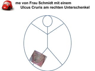 Aufnahme von Frau Schmidt mit einem  Ulcus Cruris am rechten Unterschenkel 