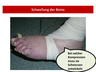 Schwellung der Beine Bei solcher Kompression muss sie Schmerzen entwickeln 