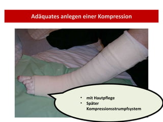 Adäquates anlegen einer Kompression mit Hautpflege Später Kompressionsstrumpfsystem 