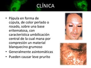 • Pápula en forma de
cúpula, de color perlado o
rosado, sobre una base
eritematosa, con
característica umbilicación
central de la cual mana por
compresión un material
blanquecino grumoso
• Generalmente asintomáticas
• Pueden causar leve prurito
CLÍNICA
 