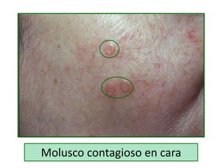 Molusco contagioso en cara
 