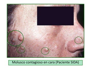 Molusco contagioso en cara (Paciente SIDA)
 