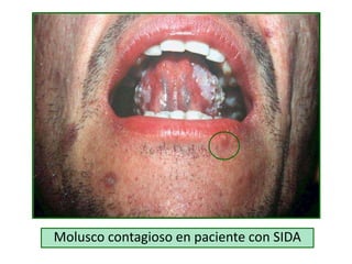 Molusco contagioso en paciente con SIDA
 