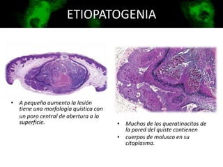 ETIOPATOGENIA
• A pequeño aumento la lesión
tiene una morfología quística con
un poro central de abertura a la
superficie. • Muchos de los queratinocitos de
la pared del quiste contienen
• cuerpos de molusco en su
citoplasma.
 
