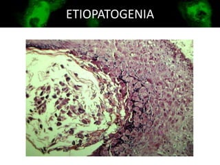 ETIOPATOGENIA
 