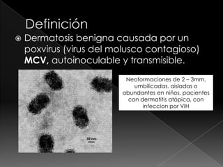    Dermatosis benigna causada por un
    poxvirus (virus del molusco contagioso)
    MCV, autoinoculable y transmisible.
                          Neoformaciones de 2 – 3mm,
                             umbilicadas, aisladas o
                         abundantes en niños, pacientes
                           con dermatitis atópica, con
                                infeccion por VIH
 