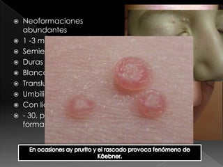  Neoformaciones
  abundantes
 1 -3 mm hasta1 cm – 3 cm
 Semiesféricas
 Duras
 Blanco amarillentas
 Translucidas
 Umbilicadas
 Con liquido grumoso
 - 30, pero también pueden
  formar placas
 