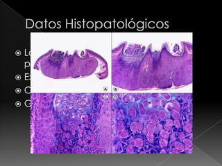  La epidermis forma lóbulos y se abre
  por un poro estrecho
 Existe un crater de quetarina
 Cuerpos de molusco
 Granulos de Lipschutz (inclusiones)
 