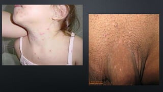 Molusco contagioso 