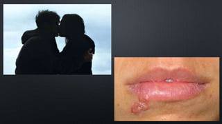 Molusco contagioso 