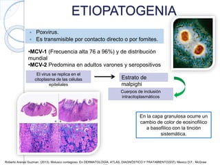 ETIOPATOGENIA
 Poxvirus.
 Es transmisible por contacto directo o por fomites.
•MCV-1 (Frecuencia alta 76 a 96%) y de distribución
mundial
•MCV-2 Predomina en adultos varones y seropositivos
El virus se replica en el
citoplasma de las células
epiteliales
Estrato de
malpighi
Cuerpos de inclusión
intracitoplasmáticos
En la capa granulosa ocurre un
cambio de color de eosinofilico
a basofilico con la tinción
sistemática.
Roberto Arenas Guzman. (2013). Molusco contagioso. En DERMATOLOGÍA, ATLAS, DIAGNÓSTICO Y TRATAMIENTO(937). Mexico D.F.: McGraw
 