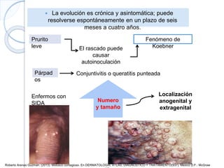  La evolución es crónica y asintomática; puede
resolverse espontáneamente en un plazo de seis
meses a cuatro años.
Prurito
leve El rascado puede
causar
autoinoculación
Fenómeno de
Koebner
Párpad
os
Conjuntivitis o queratitis punteada
Enfermos con
SIDA
Numero
y tamaño
Localización
anogenital y
extragenital
Roberto Arenas Guzman. (2013). Molusco contagioso. En DERMATOLOGÍA, ATLAS, DIAGNÓSTICO Y TRATAMIENTO(937). Mexico D.F.: McGraw
 
