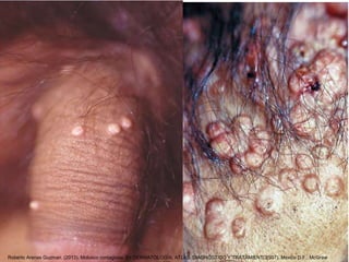 Roberto Arenas Guzman. (2013). Molusco contagioso. En DERMATOLOGÍA, ATLAS, DIAGNÓSTICO Y TRATAMIENTO(937). Mexico D.F.: McGraw
 
