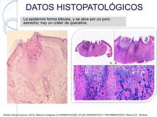 DATOS HISTOPATOLÓGICOS
La epidermis forma lóbulos, y se abre por un poro
estrecho; hay un cráter de queratina.
Roberto Arenas Guzman. (2013). Molusco contagioso. En DERMATOLOGÍA, ATLAS, DIAGNÓSTICO Y TRATAMIENTO(937). Mexico D.F.: McGraw
 