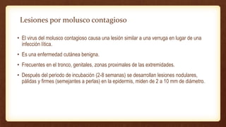 Lesiones por molusco contagioso
• El virus del molusco contagioso causa una lesión similar a una verruga en lugar de una
infección lítica.
• Es una enfermedad cutánea benigna.
• Frecuentes en el tronco, genitales, zonas proximales de las extremidades.
• Después del periodo de incubación (2-8 semanas) se desarrollan lesiones nodulares,
pálidas y firmes (semejantes a perlas) en la epidermis, miden de 2 a 10 mm de diámetro.
 