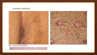Lesiones cutáneas
Lesiones:
• Son indoloras
• Apariencia umbilicada
• El poro al centro de cada lesión produce
material caseoso que puede extraerse
fácilmente (exprimirse)
• No se asocian con síntomas sistémicos
• Desaparecen de 2 a 12 meses sin tratamiento,
como consecuencia de una respuesta
inmunitaria
 