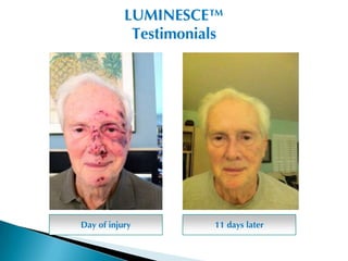 LUMINESCE™
            Testimonials




Day of injury         11 days later
 