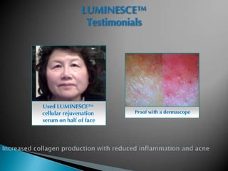LUMINESCE™
                Testimonials




Used LUMINESCE™
cellular rejuvenation    Proof with a dermascope
serum on half of face
 