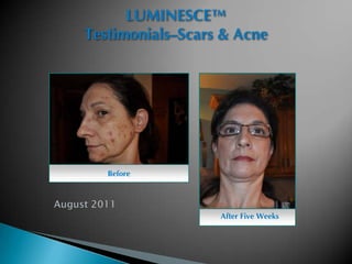 LUMINESCE™
Testimonials–Scars & Acne




   Before




                  After Five Weeks
 