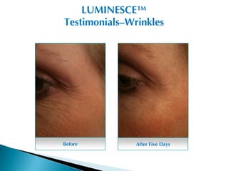 LUMINESCE™
Testimonials–Wrinkles




Before         After Five Days
 
