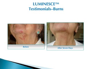 LUMINESCE™
     Testimonials–Burns




Before
                    After Seven Days
 