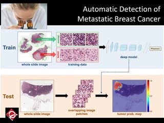 Automatic Detection of
Metastatic Breast Cancer
 