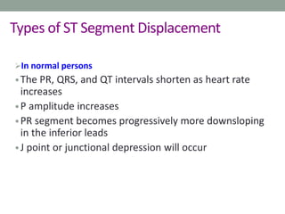 Types of ST Segment Displacement
In normal persons
•The PR, QRS, and QT intervals shorten as heart rate
increases
•P amplitude increases
•PR segment becomes progressively more downsloping
in the inferior leads
•J point or junctional depression will occur
 