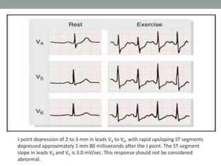 J point depression of 2 to 3 mm in leads V4 to V6, with rapid upsloping ST segments
depressed approximately 1 mm 80 milliseconds after the J point. The ST-segment
slope in leads V4 and V5 is 3.0 mV/sec. This response should not be considered
abnormal.
 